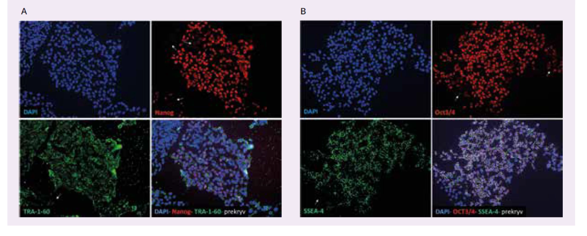 Kontrola expresie markerov pluripotencie iPSC-buniek od pacienta s Wolframovým syndrómom
– imunocytofarbenie. A – detekcia Nanog a TRA-1-60 B – detekcia Oct3/4 a SSEA-4. DAPI
(modré) farbí selektívne dvojvláknovú DNA v jadre všetkých buniek. Nanog a Oct3/4 (červené) sú
transkripčné faktory lokalizované v jadre pluripotentných buniek. TRA-1-60 a SSEA-4 (zelené) sú
povrchové markery exprimované na povrchu pluripotentných buniek. Biele šípky indikujú miesta
v iPSC-kolóniach, ktoré neexprimujú markery pluripotencie. Kolónie buniek od pacienta s Wolframovým
syndrómom teda nepredstavujú stabilné kolónie iPSC-kmeňových pluripotentných buniek.<br>
Uverejnené so súhlasom autorky T. Valkovičovej a ULB Center for Diabetes Research, Université Libre de
Bruxelles,Belgicko